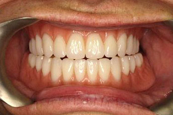 Image of Maidstone Denture Studio - Case 8
