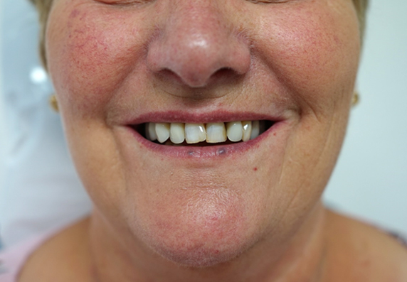 Image of Maidstone Denture Studio - after treatment