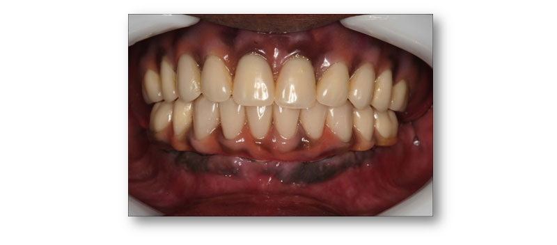 Image of Maidstone Denture Studio - Lower ALL – ON – 4