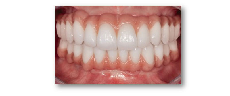 Image of Maidstone Denture Studio - Upper and Lower ALL – ON – 4