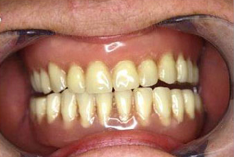 Image of Maidstone Denture Studio - Case 8