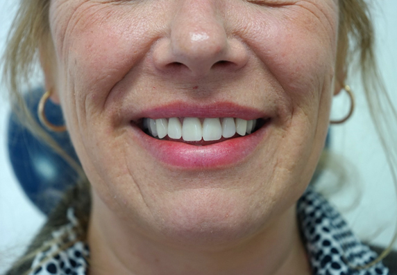 Image of Maidstone Denture Studio - after treatment
