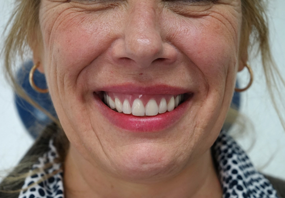 Image of Maidstone Denture Studio - before treatment